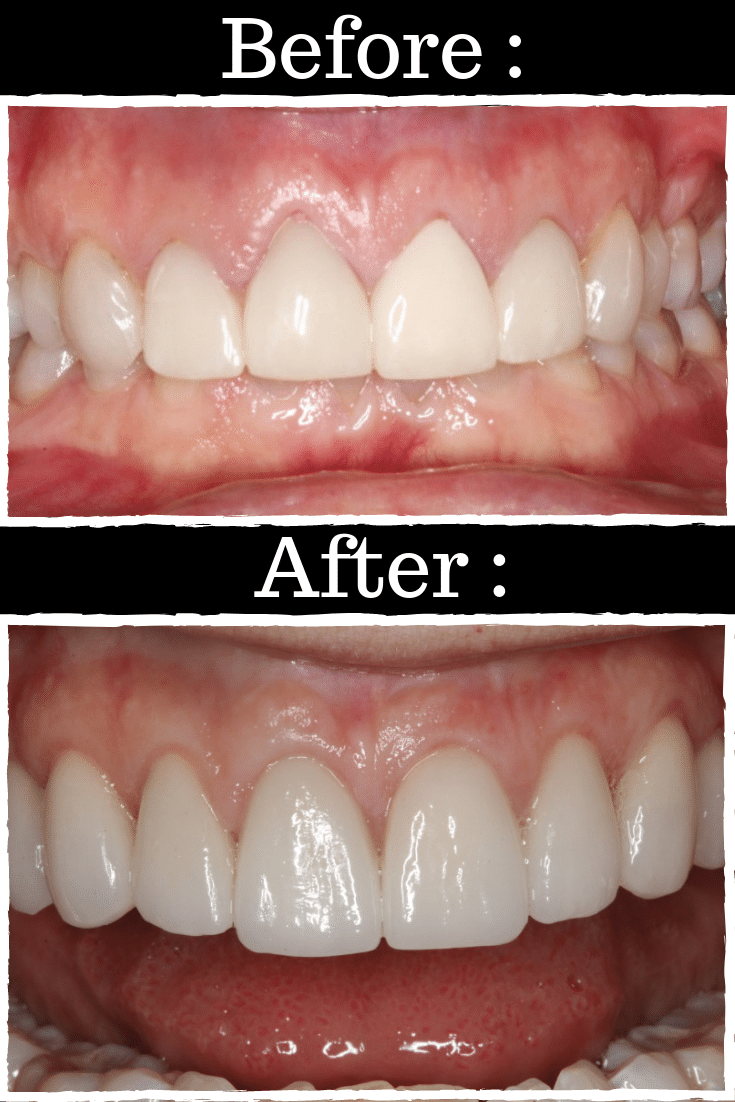 Behind the Scenes Making Your Dental Restoration What's in Your Mouth?