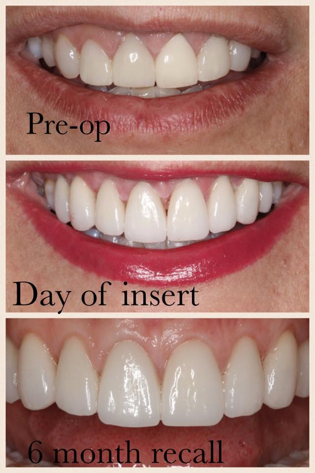 Emax Veneer Case What's in Your Mouth?