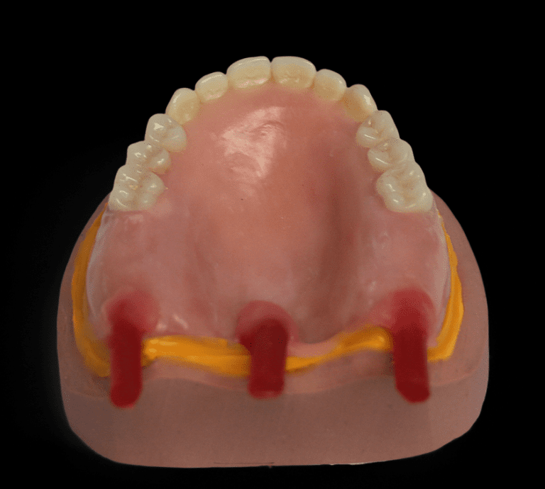 The Wax Duplicate Denture Technique A Guide for Replication Accuracy